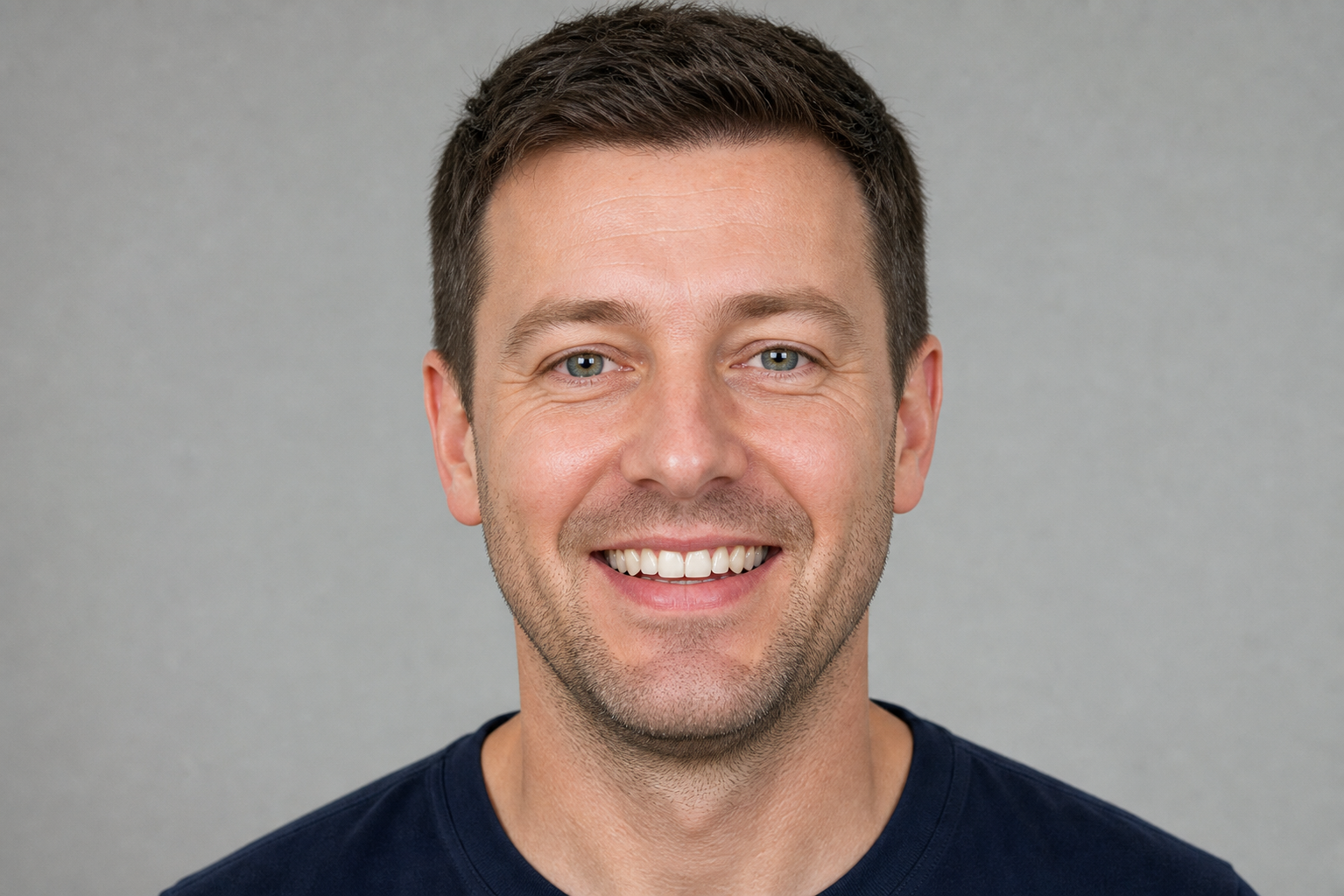 Before - Hair Transplant