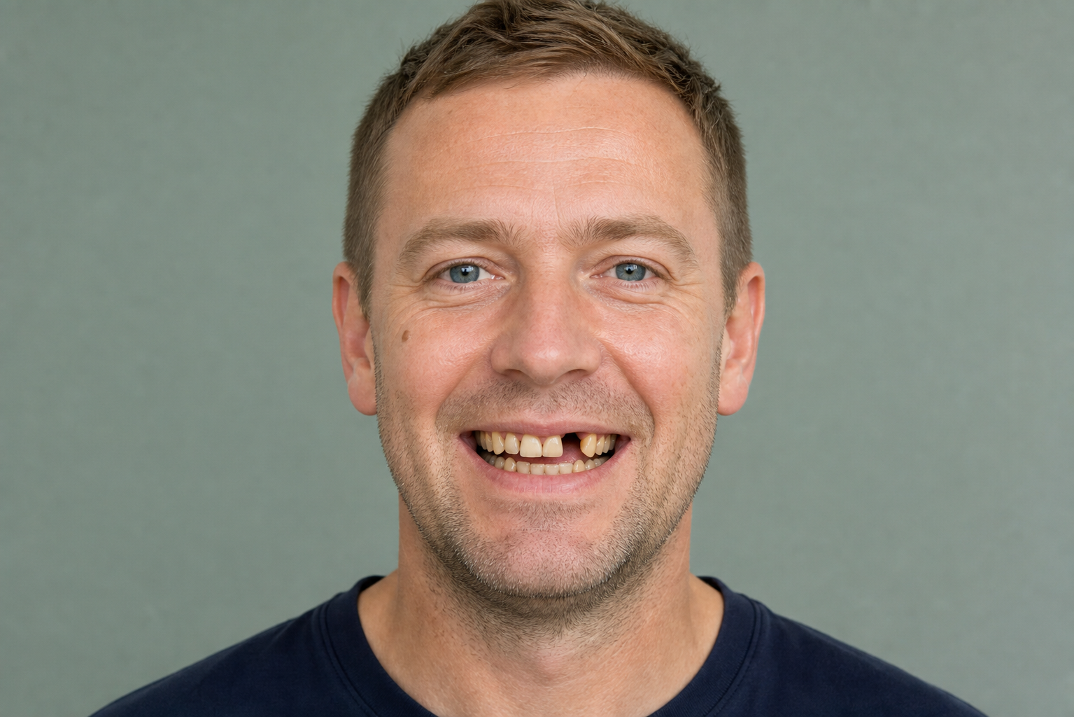 After - Implant Treatment