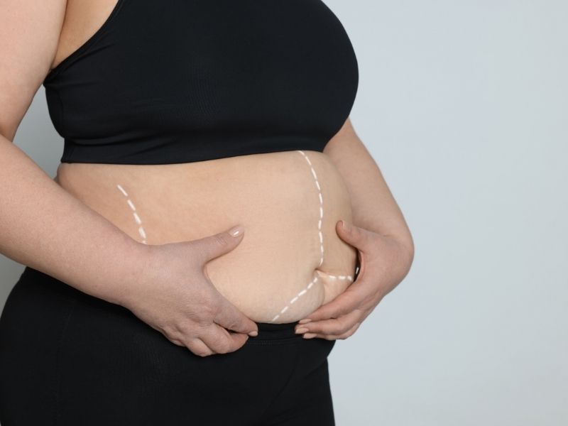 Obesity Surgery